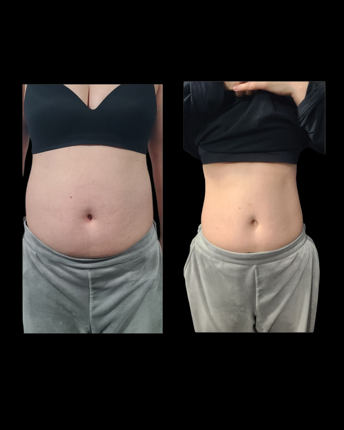 Emsculpt NEO Results 9